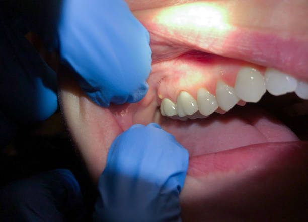 Best Chipped Tooth Repair Near Me  in Indian River Shores, FL